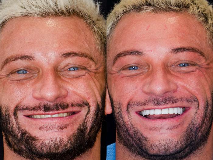 A patient is smiling before and after the lumineer treatment in Cancun.